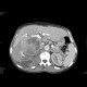 Urothelial carcinoma, gigantic: CT - Computed tomography